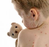Ministerul Sănătății, Muncii și Protecției Sociale întreprinde toate măsurile privind lichidarea focarului existent de rujeola și prevenirea epidemiei în țară